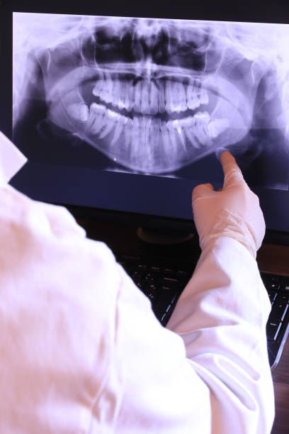 Best Knocked-Out Tooth (Avulsed Tooth) Treatment in Millbrae, CA